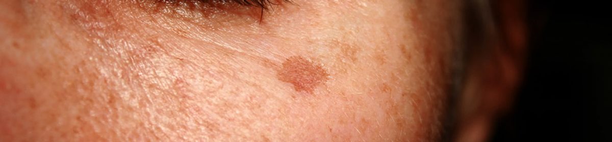 Reversing-Sun-Damaged-Skin-Dermatology-in-Keller-TX